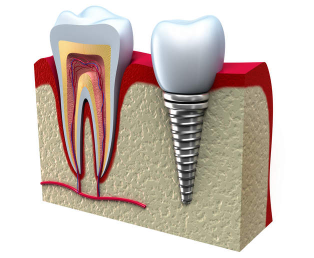 Как выглядит зубной имплантат Зубной имплантат