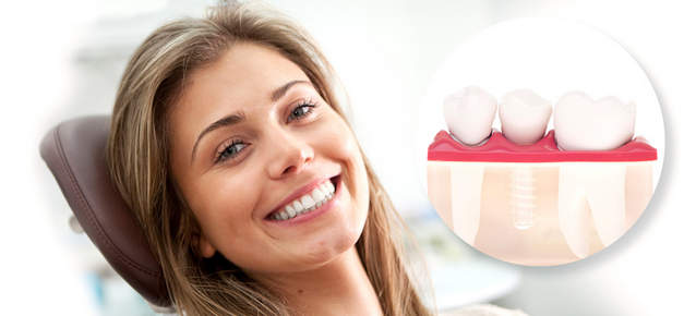 Выбор типа и производителя зубных имплантатов должен производиться квалифицированным врачом-имплантологом Какие импланты лучше