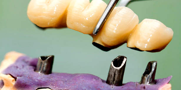 Протезирование зубов на имплантатах Протезирование зубов на имплантатах