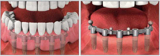 Съемный протез на имплантах с балочным креплением Съемный протез на имплантах с балочным креплением