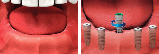 Несъемное протезирование на имплантах Несъемное протезирование на имплантах