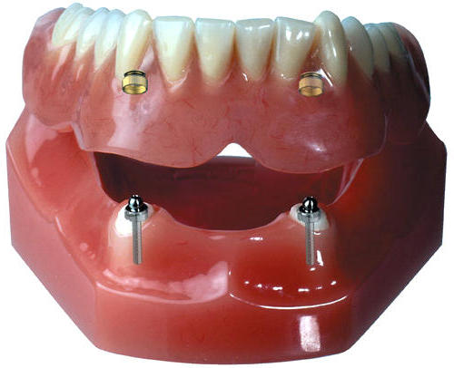 Вариант крепления несъемного протеза нижней челюсти Крепление несъемного протеза