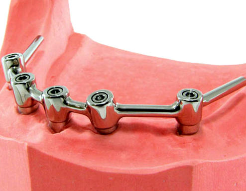 Установка несъемного протеза на нижнюю челюсть Установка несъемного протеза на нижнюю челюсть