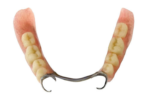 Бюгельный съемный зубной протез