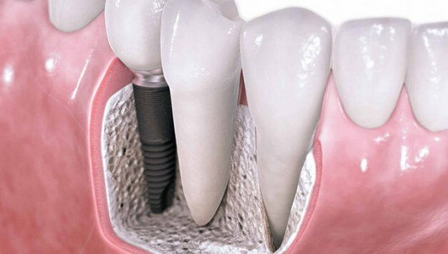 Имплантация зубов