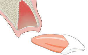 Реплантация — возвращение зуба в лунку Реплантация зуба