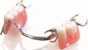 Бюгельный протез Протезирование зубов