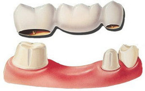 Зубной мост Мостовидный протез