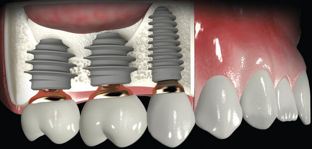Верхняя челюсть обладает меньшей плотностью, поэтому требуются удлиненные модели имплантов, которые могут вызвать осложнения Имплантация на верхней челюсти