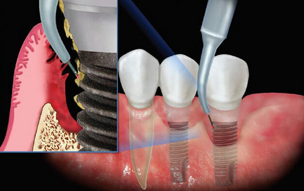 Как лечат периимплантит нехирургическим путем Лечение периимплантита