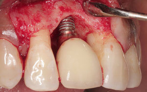 Отторжение импланта