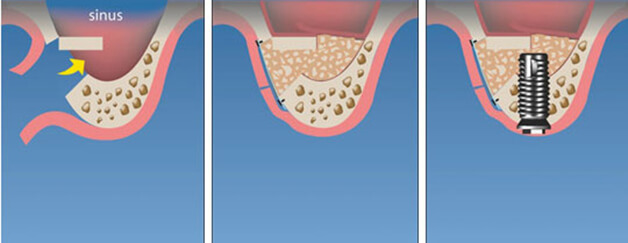 Открытый синус-лифтинг