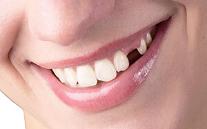 Отсутствие зуба