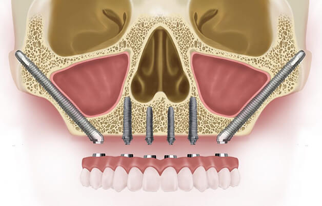 Скуловая имплантация