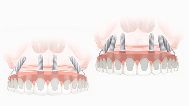 Имплантация с вживлением четырех или шести имплантов 4 и 6 импланта