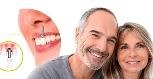 Требования к эстетике верхнего зубного ряда завышенные, ведь при улыбке верхняя челюсть визуализируется больше Имплантация верхних зубов