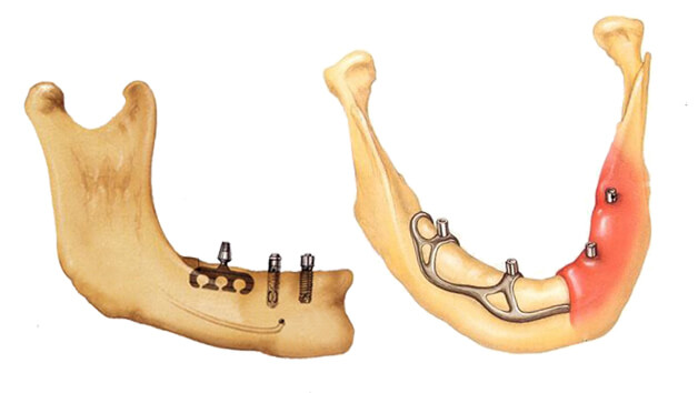На фото слева направо: эндооссальный и субпериостальный тип конструкций имплантов Тип конструкций