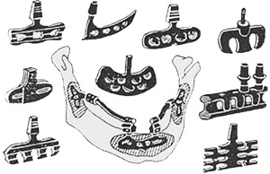 Конструкции металлических пластиночных эндооссальных имплантатов Эндооссальный тип