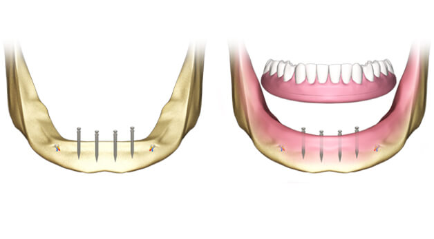 Мини-импланты